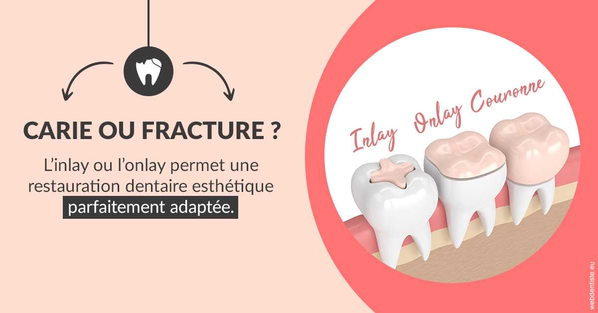 https://dr-hoffmann-julie.chirurgiens-dentistes.fr/T2 2023 - Carie ou fracture 2
