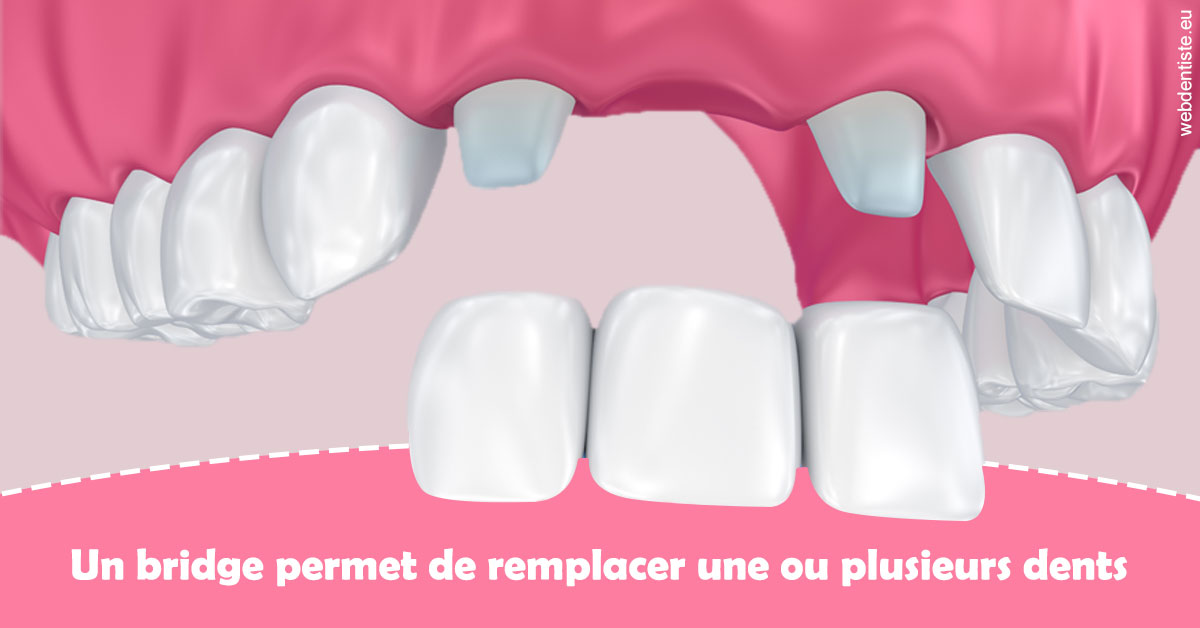 https://dr-hoffmann-julie.chirurgiens-dentistes.fr/Bridge remplacer dents 2