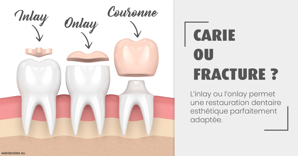 https://dr-hoffmann-julie.chirurgiens-dentistes.fr/T2 2023 - Carie ou fracture 1