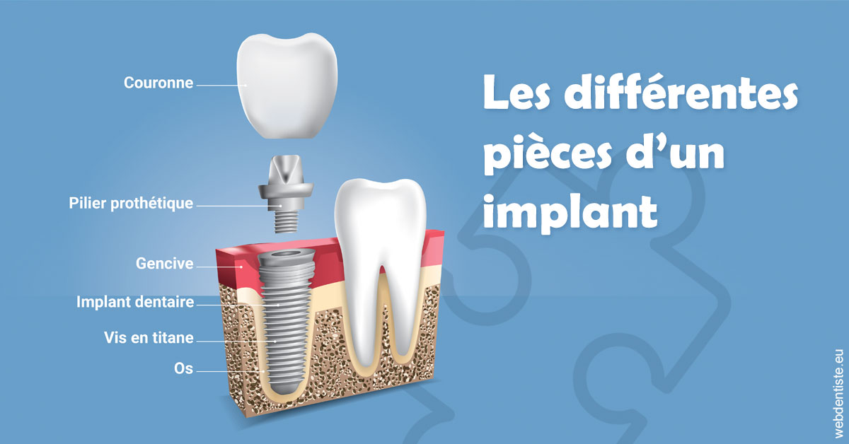 https://dr-hoffmann-julie.chirurgiens-dentistes.fr/Les différentes pièces d’un implant 1