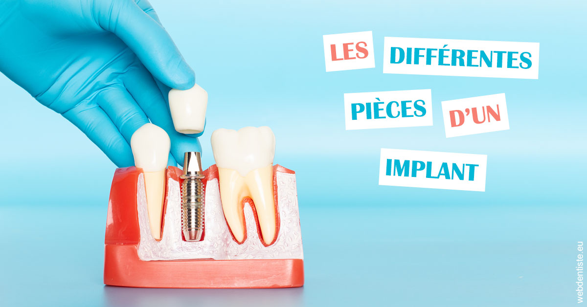 https://dr-hoffmann-julie.chirurgiens-dentistes.fr/Les différentes pièces d’un implant 2